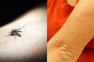 10 Cara menghilangkan bekas gigitan nyamuk, alami & mudah
