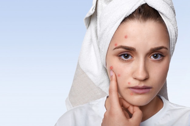 35 Cara menghilangkan jerawat di wajah & punggung secara alami, ampuh