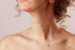 5 Cara menghilangkan bekas cacar, mudah, efektif, dan cepat