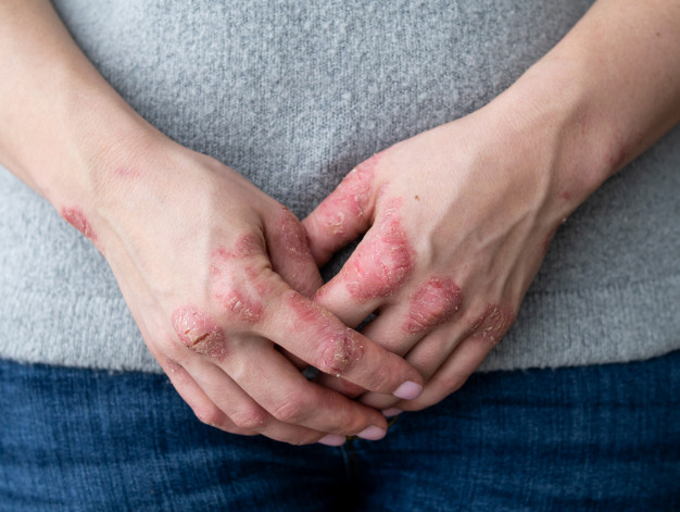 11 Jenis penyakit kulit dan cara alami mengatasinya