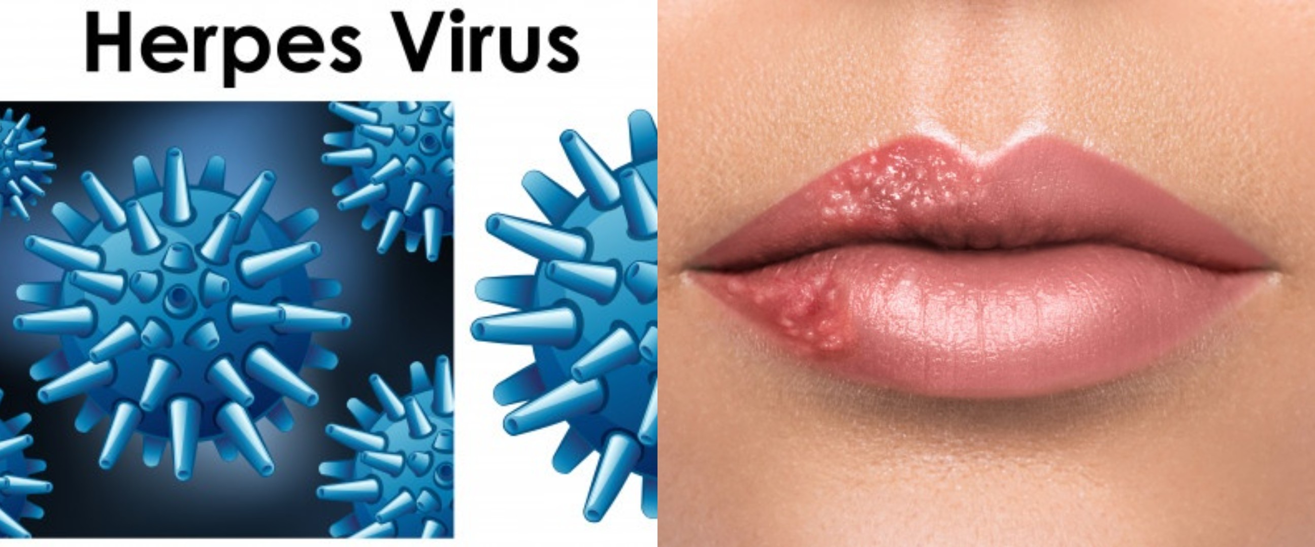 15 Gejala penyakit herpes, penjelasan penyebab, dan cara mengobatinya