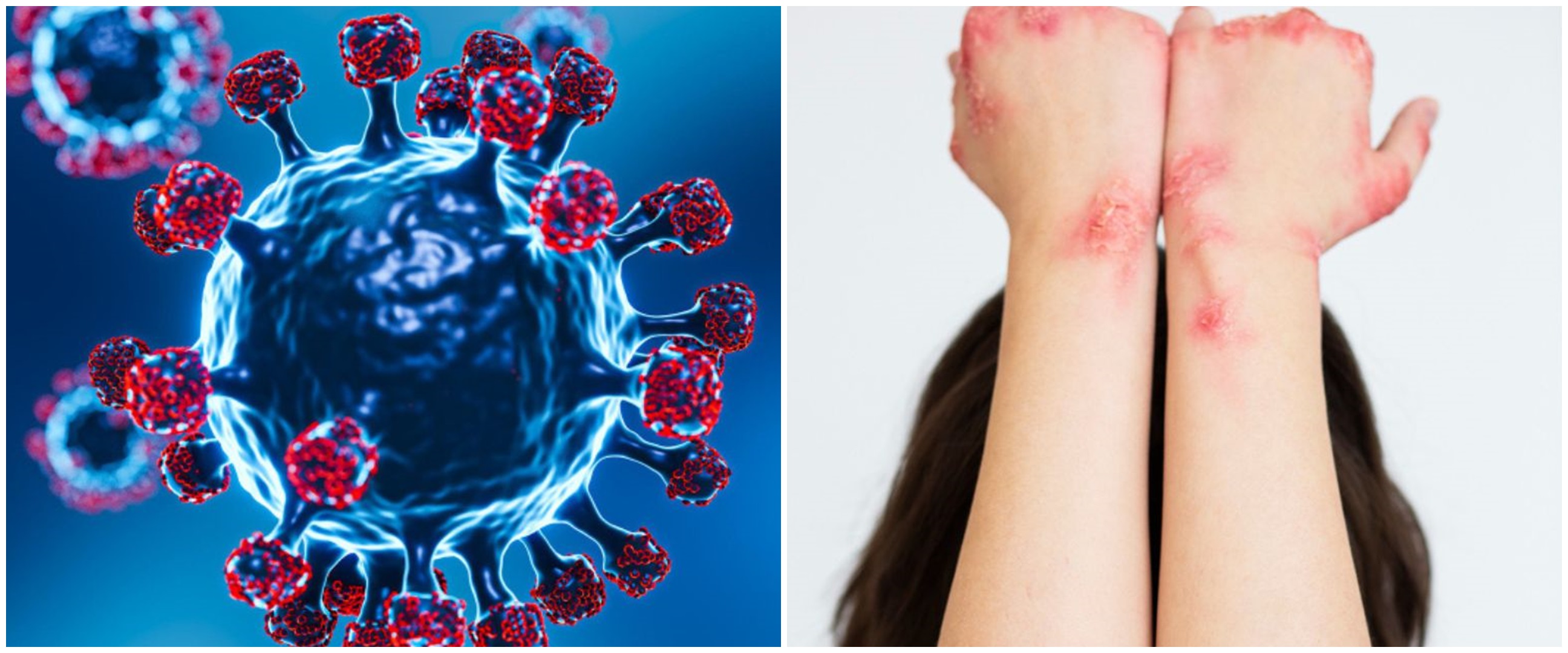 15 Gejala penyakit herpes, penjelasan penyebab, dan cara mengobatinya