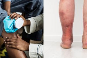 15 Penyebab kaki bengkak yang perlu diwaspadai dan cara mengatasinya