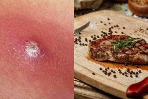 11 Penyebab bisul, gejala, dan cara alami mengobatinya