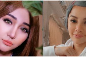 Beda penampilan 6 seleb sebelum & sesudah filler bibir