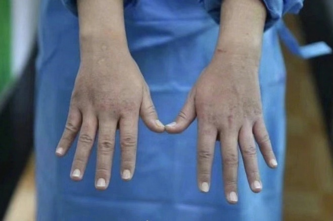 7 Foto kondisi wajah & tangan perawat urusi pasien virus Corona