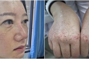 7 Foto kondisi wajah & tangan perawat urusi pasien virus Corona