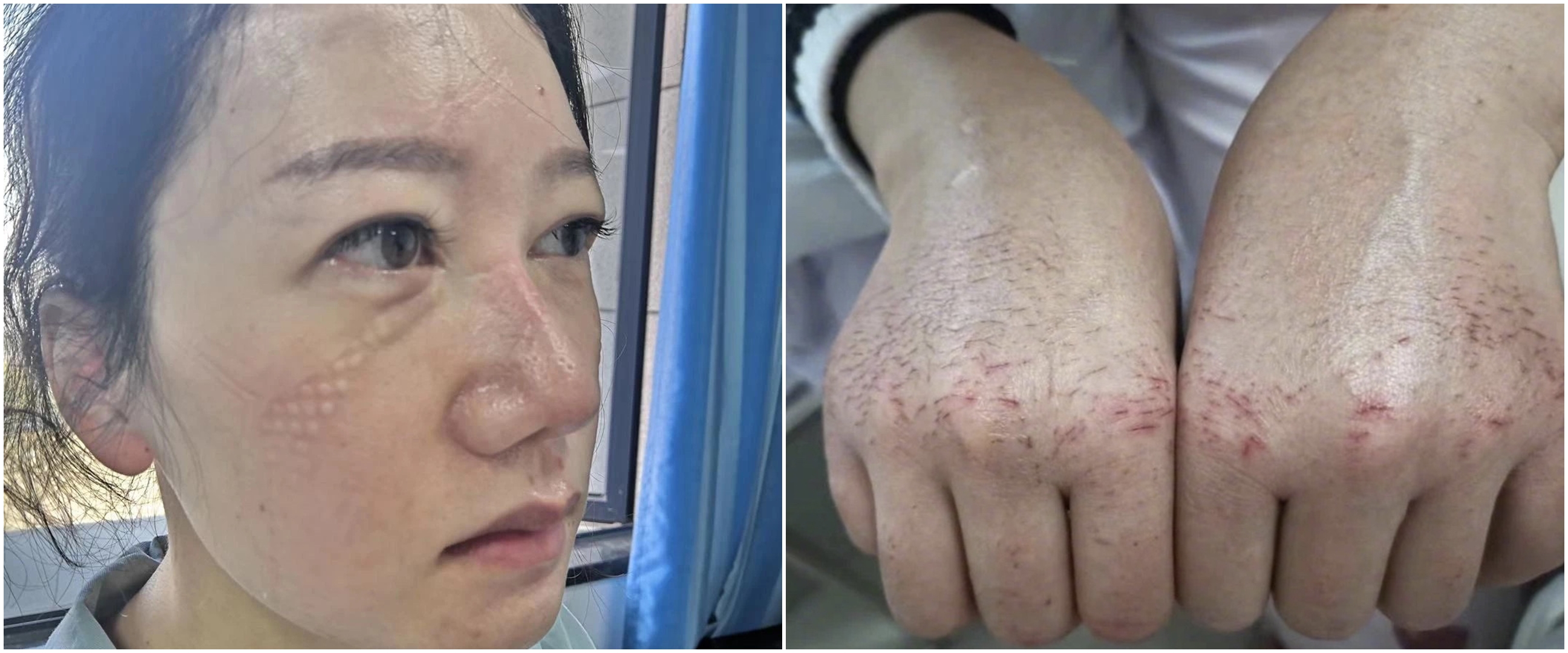 7 Foto kondisi wajah & tangan perawat urusi pasien virus Corona