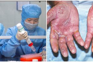 6 Foto kondisi tangan tenaga medis rawat pasien virus Corona