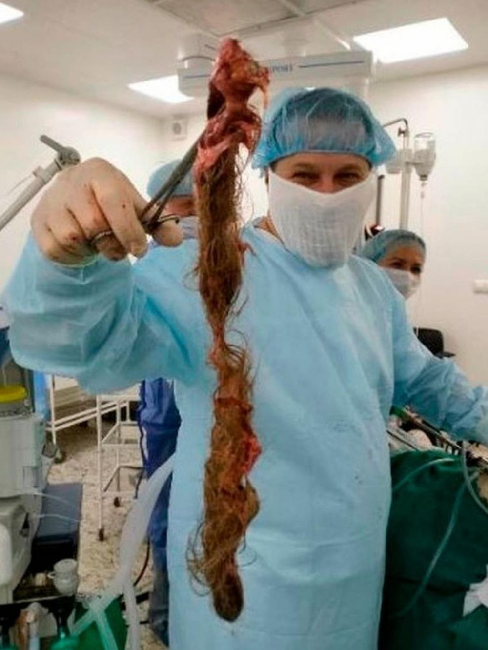 Wanita ini mengeluh sakit perut, dokter temukan kista gumpalan rambut