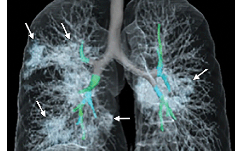 Begini potret penampakan paru-paru terjangkit virus Corona