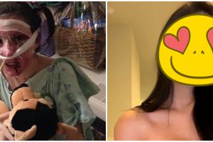 Kisah wanita alami luka bakar, 8 transformasinya bikin takjub