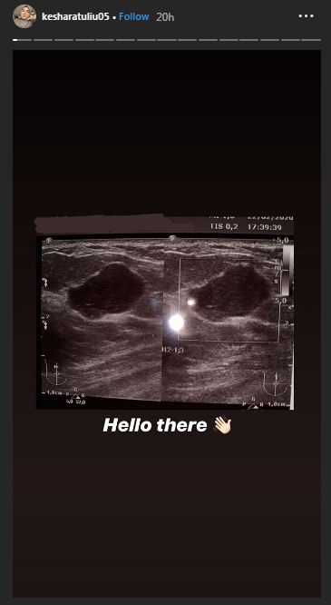 Kesha Ratuliu unggah hasil USG payudara, warganet heboh