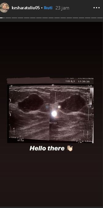 Dihujat usai unggah hasil USG payudara, ini curhatan Kesha Ratuliu