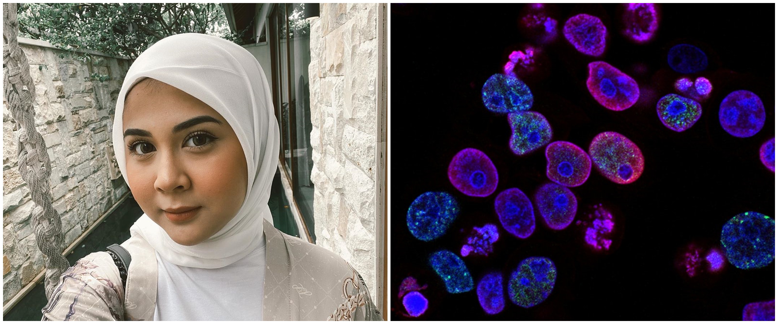 Jenis dan ciri tumor payudara seperti yang dialami Kesha Ratuliu