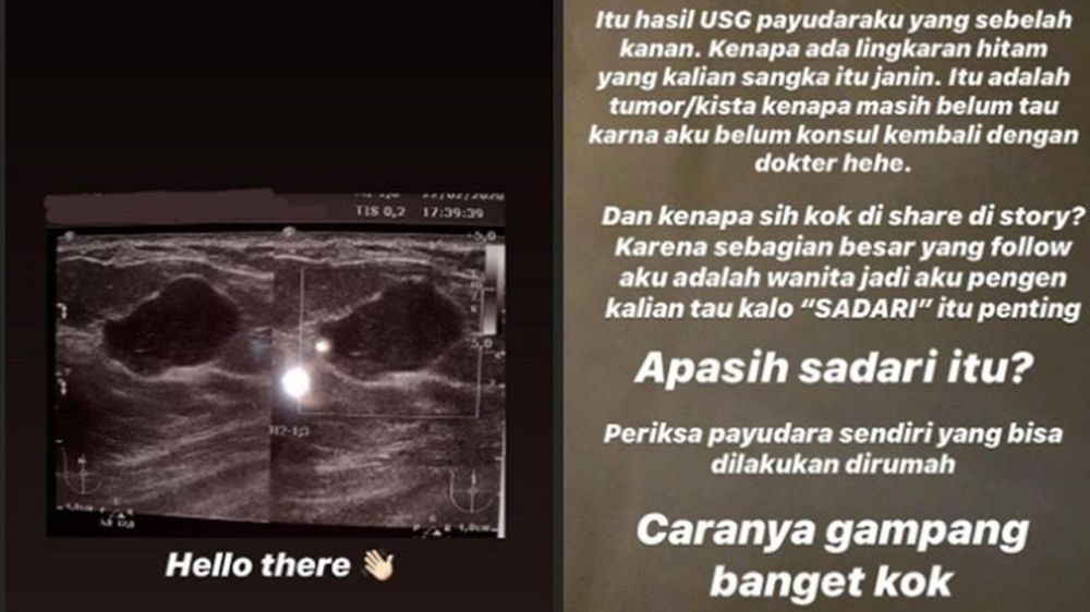 Kisah perjuangan Kesha Ratuliu & 5 seleb hadapi tumor payudara