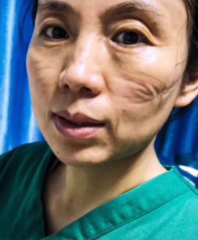 Viral potret petugas medis pasien Corona, wajah memar hingga luka