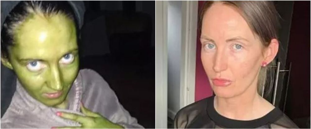 Niat ubah warna kulit, wanita ini alami kejadian apes