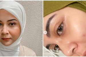 7 Seleb cantik ini tak segan pamer wajah jerawatan