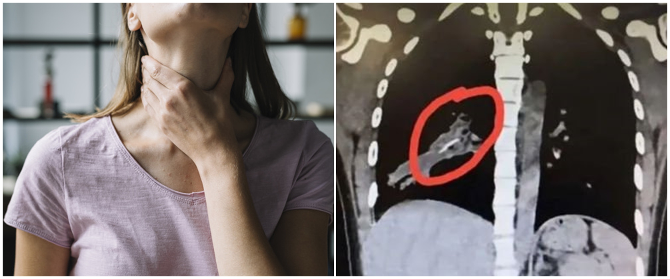 Cewek ini sering batuk selama 14 tahun, penyebabnya bikin kaget