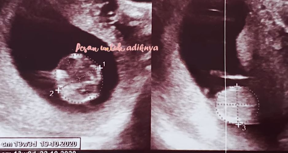 7 Momen manis Ringgo Agus Rahman & istri umumkan kehamilan