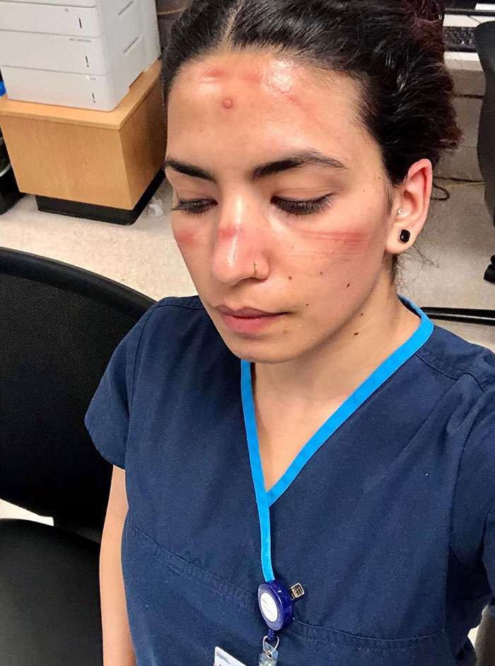 10 Potret haru tim medis usai bekerja terlalu lama, wajah penuh luka