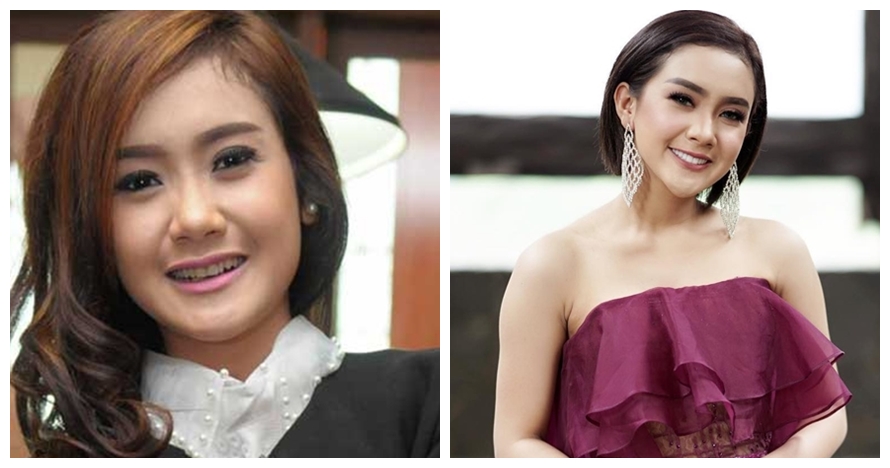 Potret 10 seleb cantik sebelum vs sesudah veneer gigi, manglingi