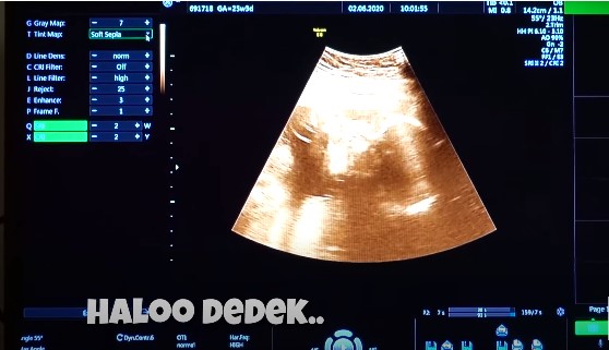 8 Momen Citra Kirana cek kandungan, hasil USG bikin penasaran