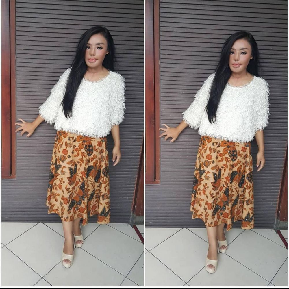 Ingat Lisa 'face off' korban siram air keras? Ini 6 kabar terkininya