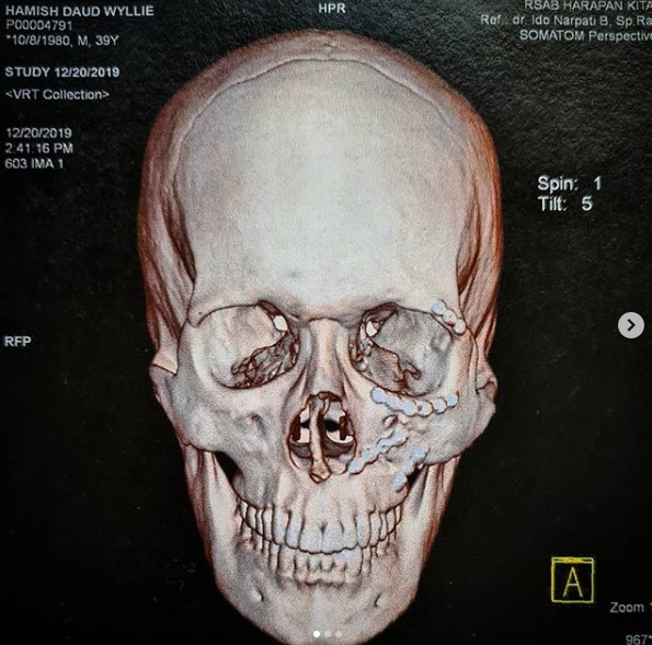 Hamish Daud unggah foto X-Ray tengkorak kepalanya, penuh baut