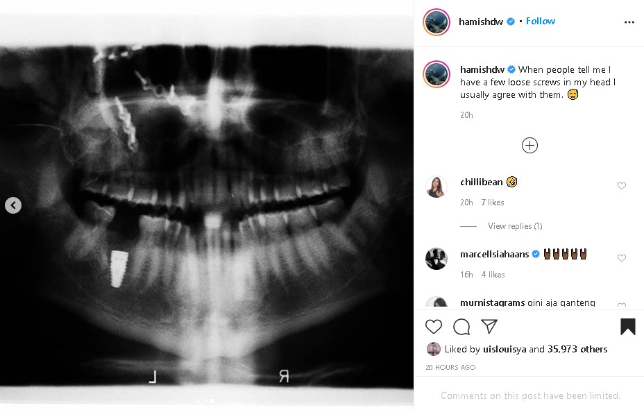 Hamish Daud unggah foto X-Ray tengkorak kepalanya, penuh baut