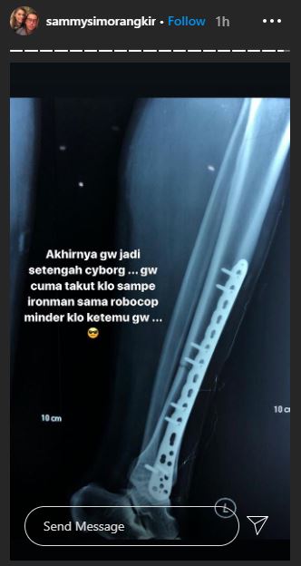 7 Potret kondisi Sammy Simorangkir usai operasi tulang kaki