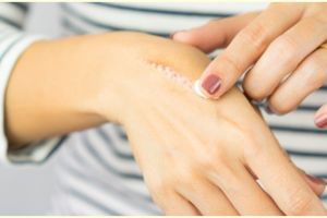 7 Cara menghilangkan bekas luka yang menghitam dengan bahan alami