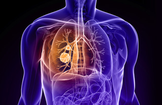 10 Manfaat bawang putih untuk kesehatan, menurunkan risiko kanker