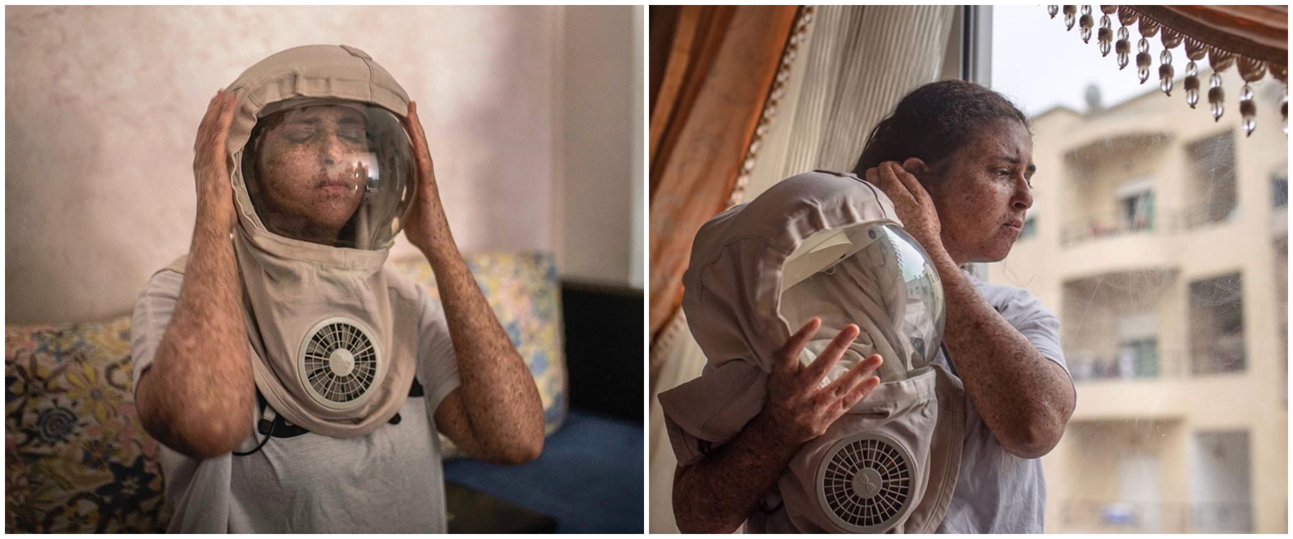 Kisah wanita pakai helm 20 tahun jika ke luar rumah, ini 8 potretnya