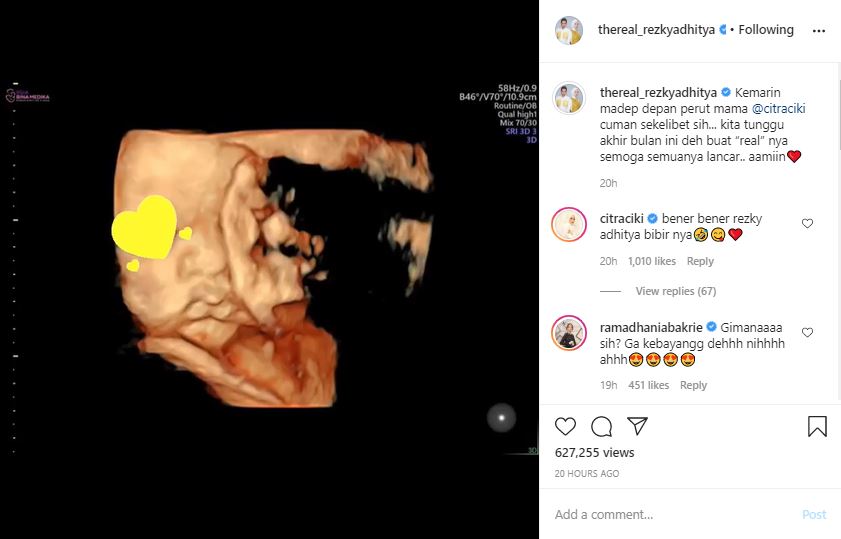 Rezky Aditya unggah wajah calon bayinya, bibirnya curi perhatian