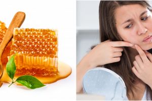 8 Cara mengobati jerawat dengan madu, aman untuk kulit