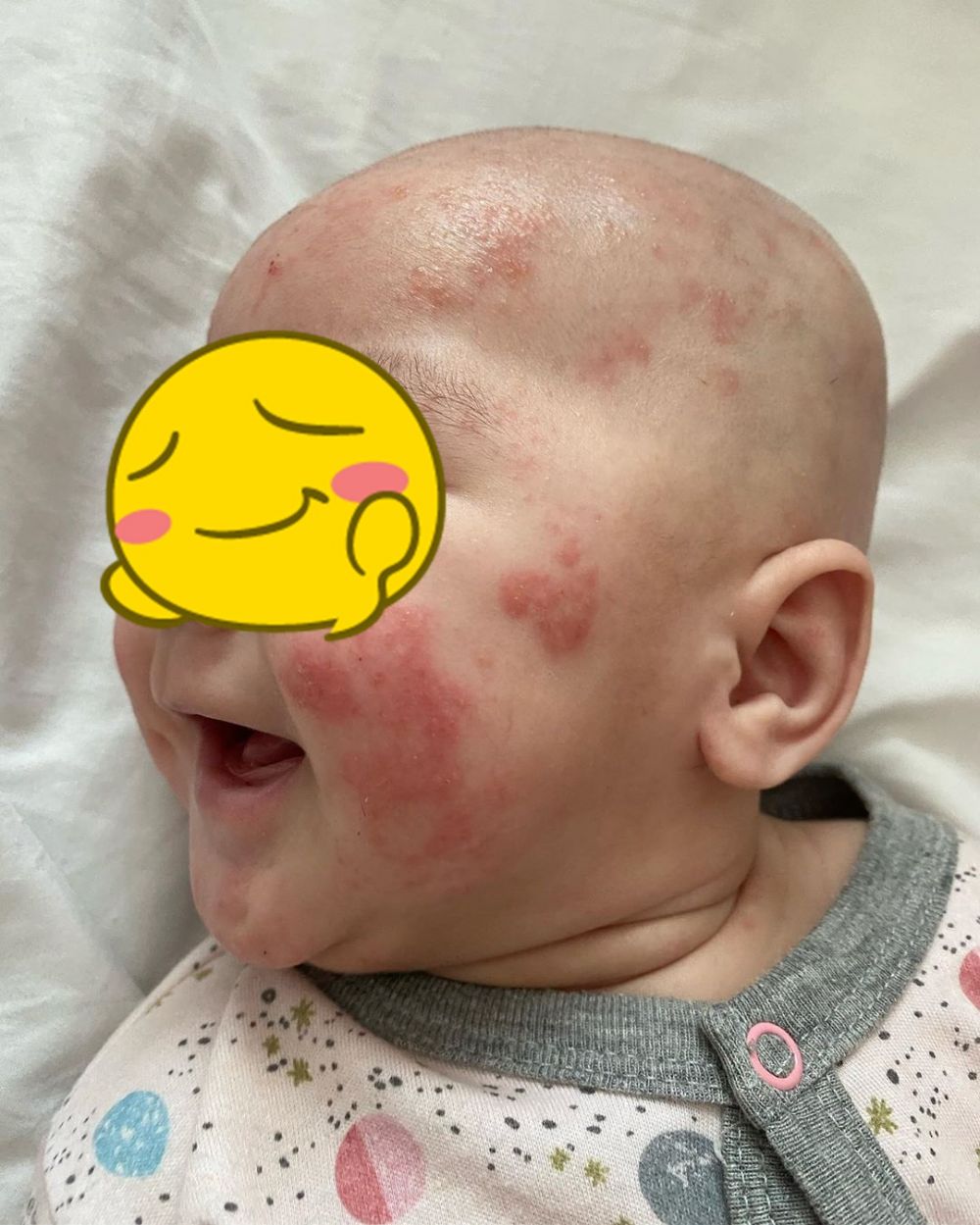 9 Potret perjuangan Mona Ratuliu rawat anak idap dermatitis atopik