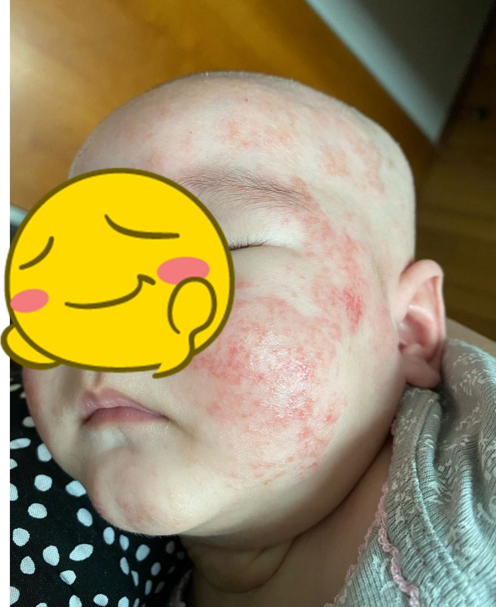 9 Potret perjuangan Mona Ratuliu rawat anak idap dermatitis atopik