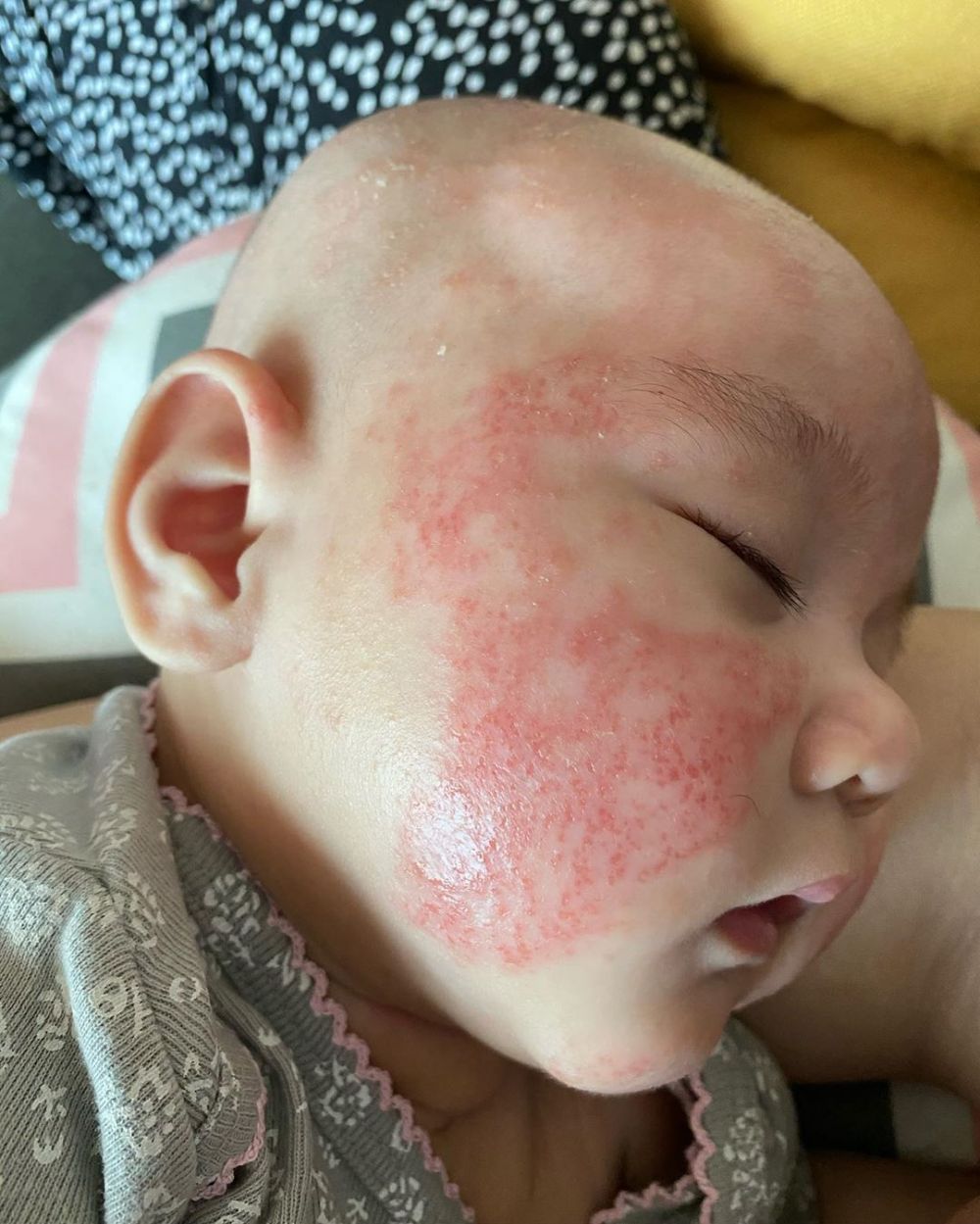 9 Potret perjuangan Mona Ratuliu rawat anak idap dermatitis atopik