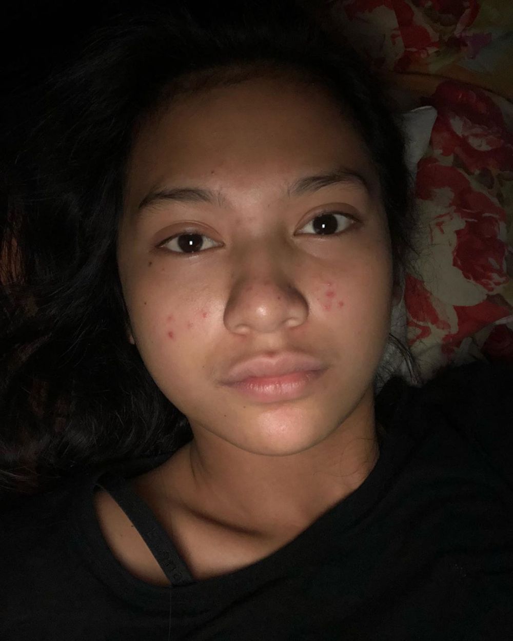Unggah potret wajah jerawatan, Indah Permatasari tuai pujian