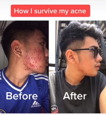 Dulu gendut & jerawatan, 10 transformasi lelaki ini bikin pangling