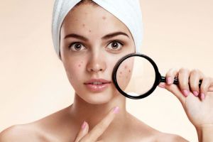 10 Fakta jerawat dan cara mengatasinya, nggak perlu stres dan panik ya