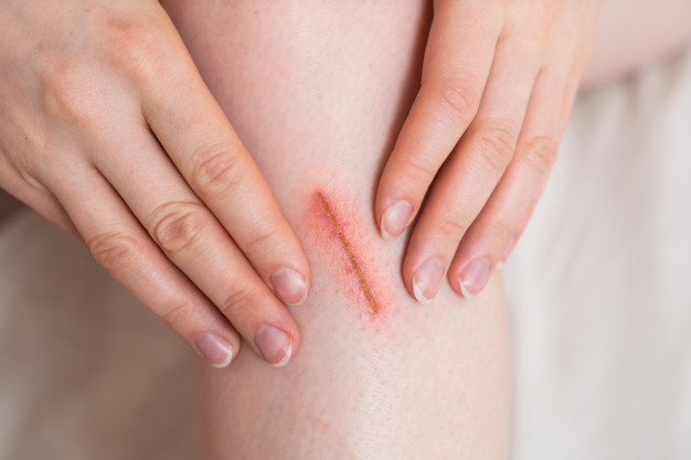 10 Manfaat minyak kemiri untuk kecantikan, cegah penuaan dini