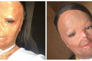 Kisah perjuangan gadis yang tubuhnya terbakar & koma 2 bulan