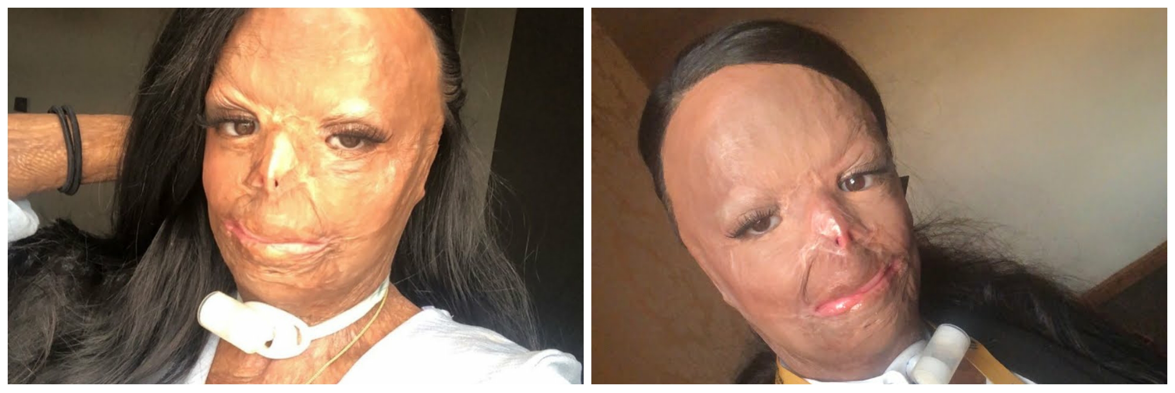 Kisah perjuangan gadis yang tubuhnya terbakar & koma 2 bulan