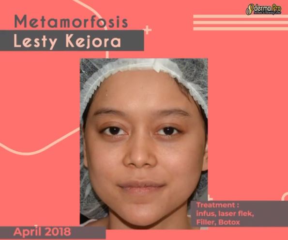 Potret perbedaan wajah Lesty Kejora sebelum & usai botox dan filler