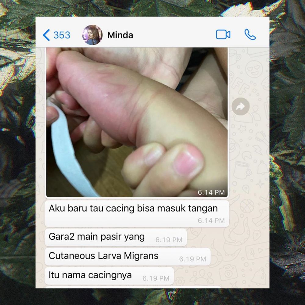 Anji ungkap tangan anaknya kemasukan cacing, begini penampakannya