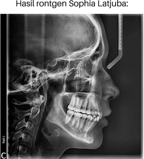 Viral hasil rontgen Sophia Latjuba, dinilai cantik sampai ke tengkorak