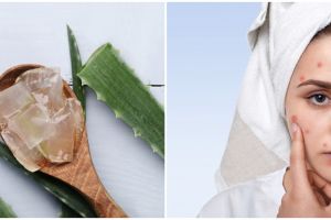 Cara membuat masker lidah buaya untuk hilangkan jerawat, mudah & aman